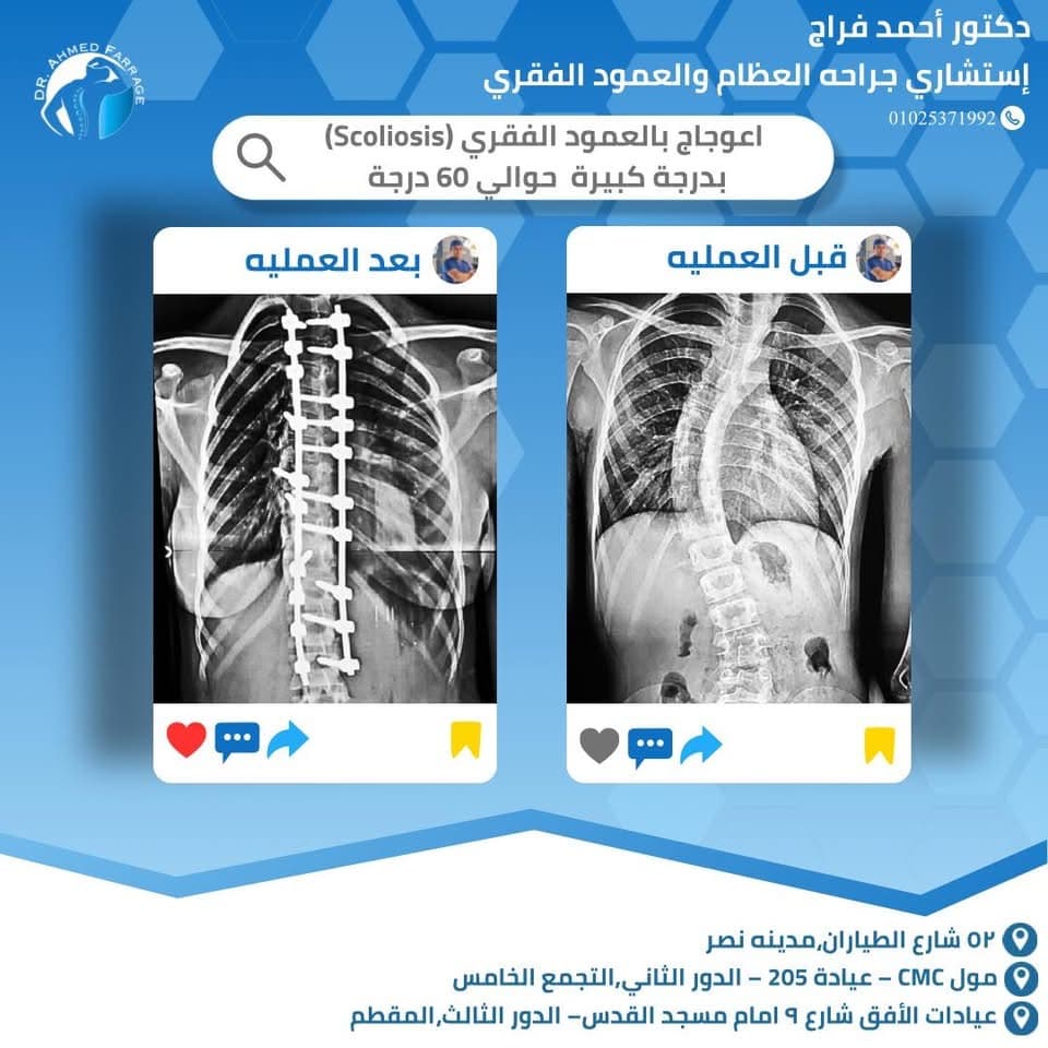 إعوجاج بالعمود الفقري بدرجة كبيرة وصلت لحوالي 60 درجة