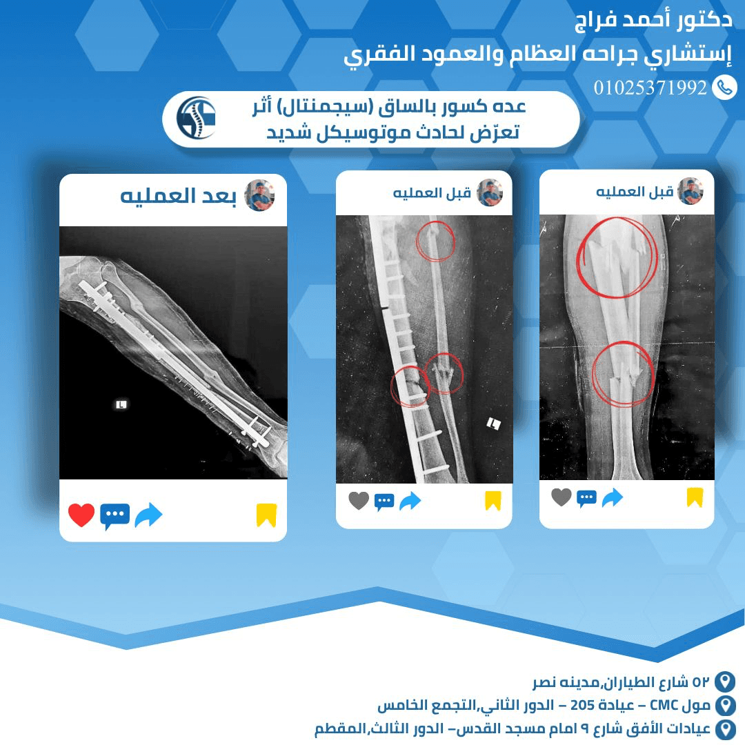 عده كسور بالساق (سيجمنتال) أثر تعرض لحادث موتوسيكل شديد