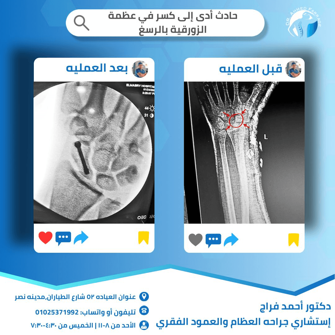 حادث أدي  إلي كسر في عظمه الزورقيه