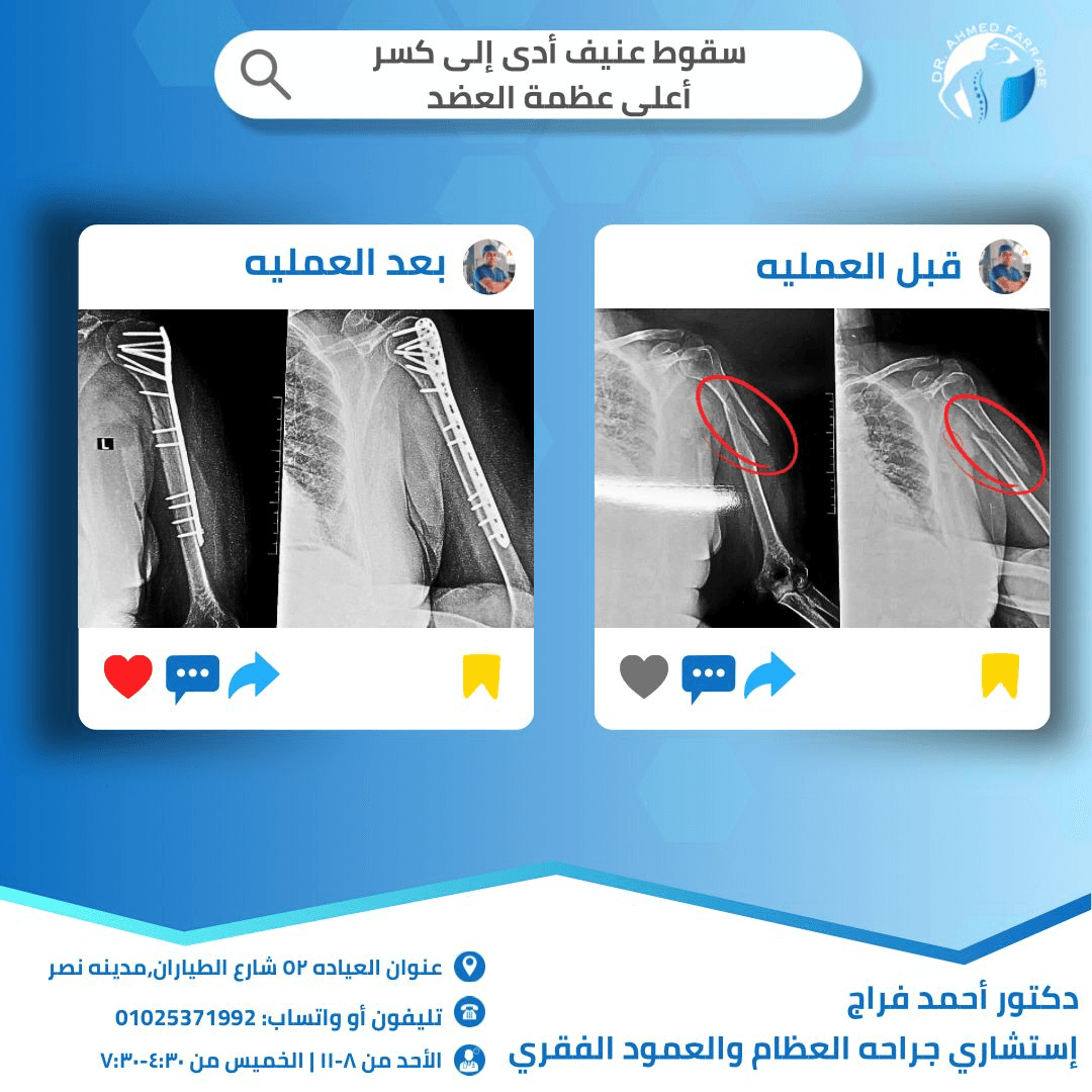 سقوط عنيف أدي الي كسر اعلي عظمه العضد