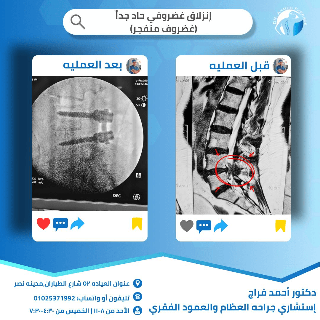 إنزلاق غضروفي حاد(غضروف منفجر)